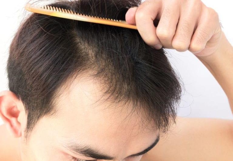 Considering a Hair Transplant? Here’s What You Need to Know