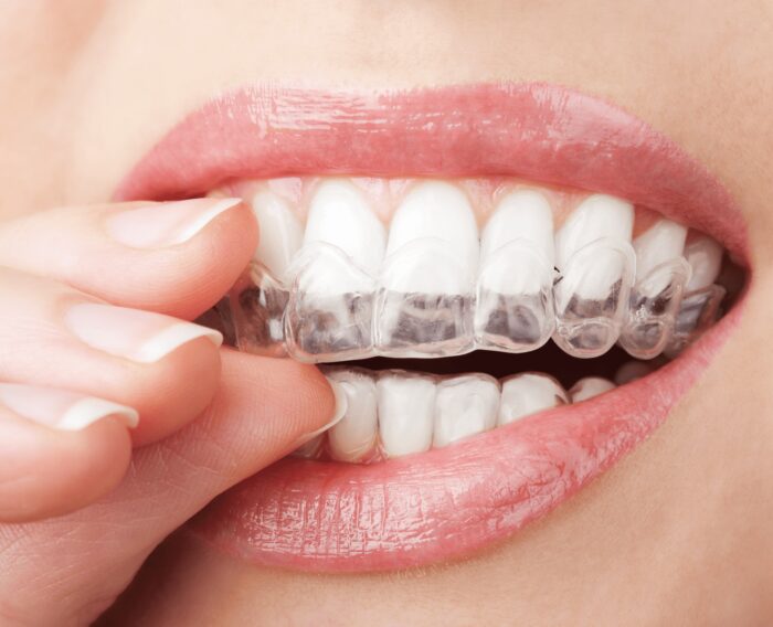 Découvrez les types d’orthodontie invisible et leurs caractéristiques